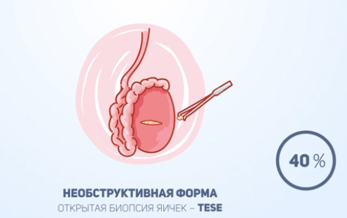 вероятность извлечения сперматозоидов различными методами биопсии
