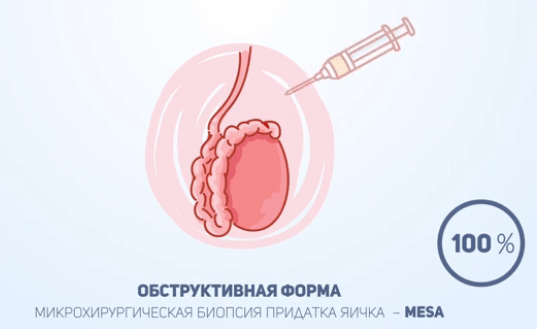 вероятность извлечения сперматозоидов различными методами биопсии